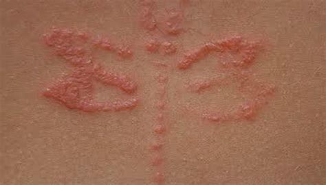 Rash - Causes, Types, Symptoms And Other Associated Risk Factors