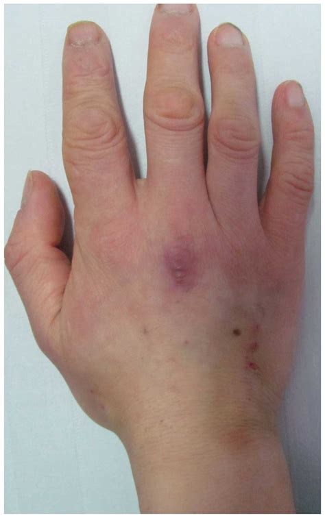 Acute basophilic leukemia presenting with maculopapular rashes and a ...