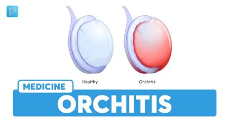 Orchitis: Causes, Symptoms, Risk Factors, Diagnosis, Treatment ...