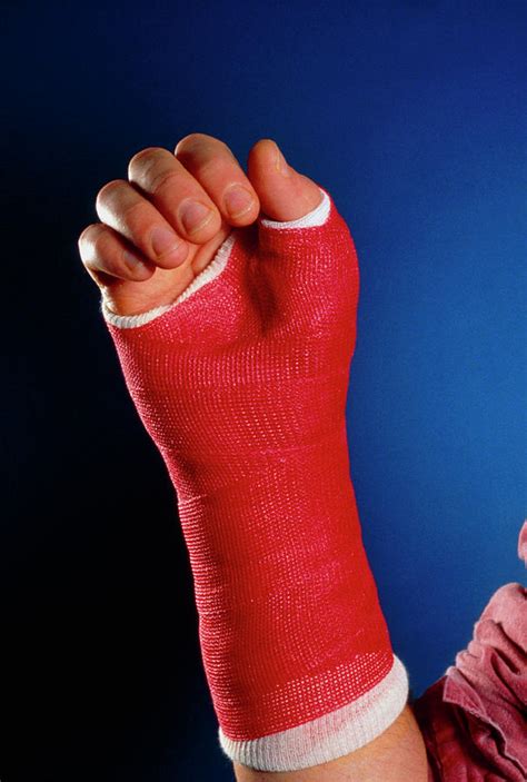 Injured Wrist Bandaged With A Fibreglass Cast Photograph by Medical Photo Nhs Lothian/science ...