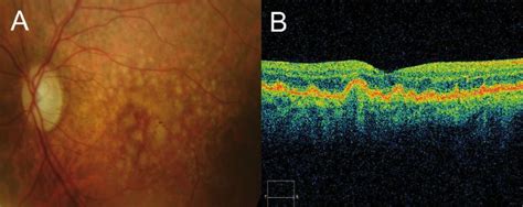 Optical Coherence Tomography in Age-related Macular Degeneration | www ...