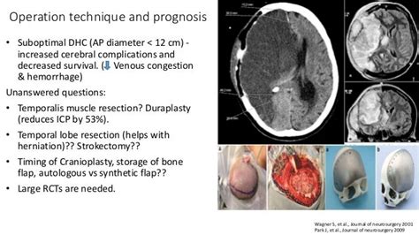 Decompressive hemicraniectomy for Large Hemispheric infarction