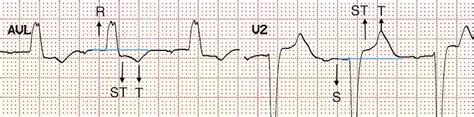 Premature Ventricular Complex (PVC) • LITFL • ECG Library Diagnosis