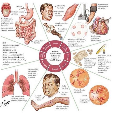 Uremia | Nursing notes, Medical education, Nursing study