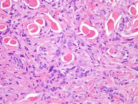 Dermatofibroma Histology