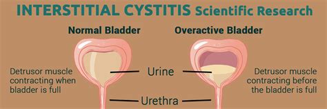 Pin on Interstitial Cystitis