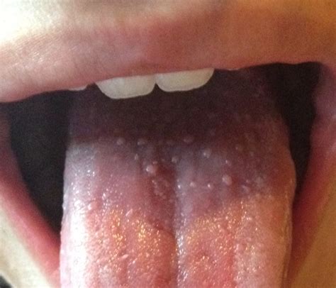 Suffering From White Tongue Sore Throat? Causes and Remedies For Quick Relief