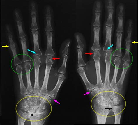 Rheumatoid Arthritis Hand X Ray