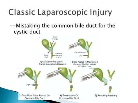 Bile Duct Injuries Following Gallbladder Surgery – Dr Faisal Dar