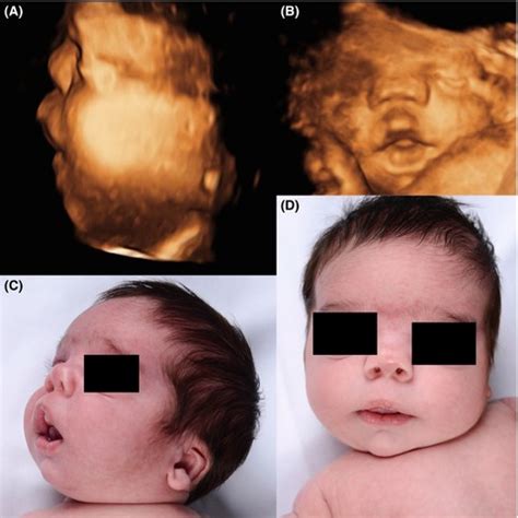 Prenatal diagnosis of autosomal recessive Robinow syndrome using 3D ...