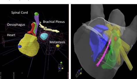 Figure 1 from Stereotactic Ablative Body Radiotherapy for Lung ...