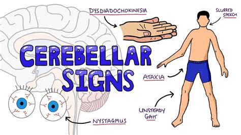 Cerebellar Dysfunction Signs Mnemonic - DANISH: What are the Signs of Cerebellar Dysfunction ...