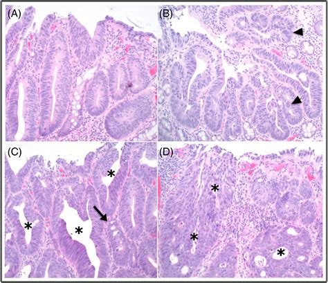 Adenomatous Polyp Histology