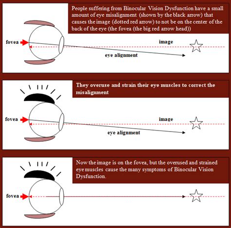 Symptoms of Binocular Vision Dysfunction - VS of M