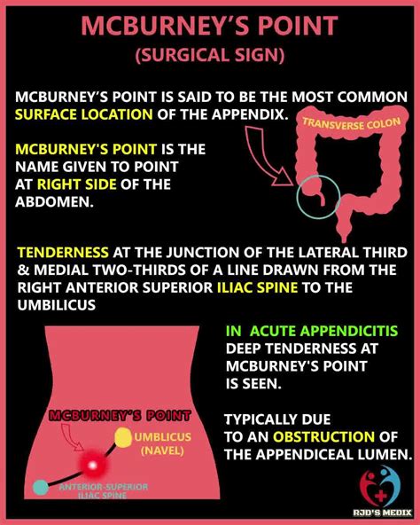 McBurney's point is the name given to the point over the right side of the abdomen.⁣#N#The sign ...