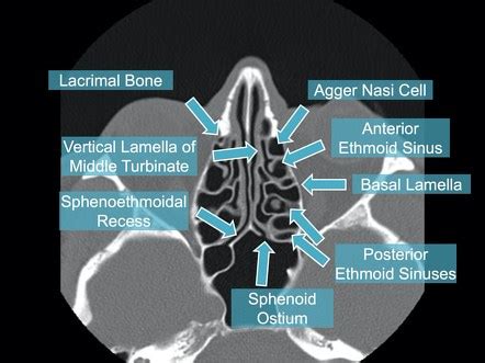 Maxillary Sinus Anatomy Radiology