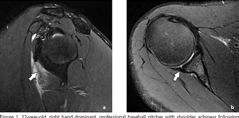 Figure 1 from Subscapularis Myotendinous Junction Tears Presenting with Posterior Shoulder Pain ...