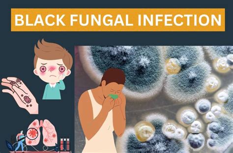 Black Fungus Symptoms, Diagnosis And Treatment