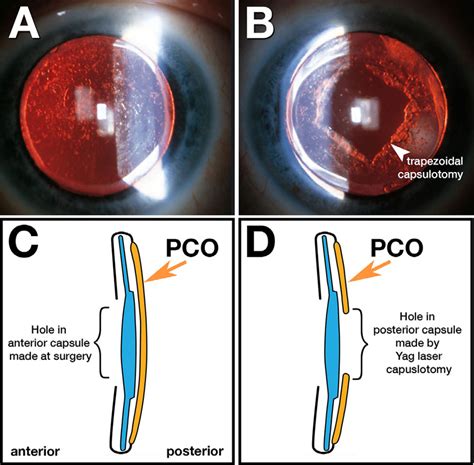 Posterior capsular opacification following intraocular lens implant.... | Download Scientific ...