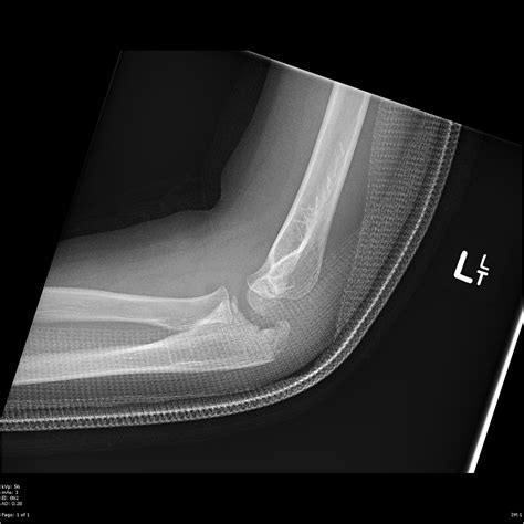 Olecranon fractures - Don't Forget the Bubbles