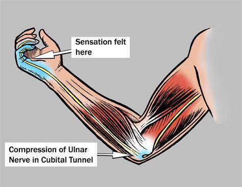 Cubital Tunnel Syndrome...What's That? - Alexandria Rehabilitation