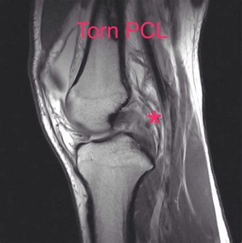 PCL Surgery Success Rate | PCL Tear | SportsMD