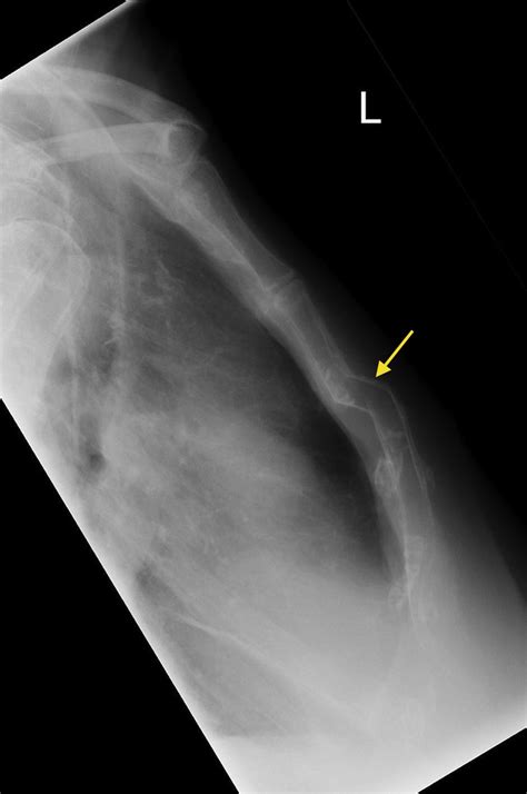 Sternal fracture - Radiology at St. Vincent's University Hospital