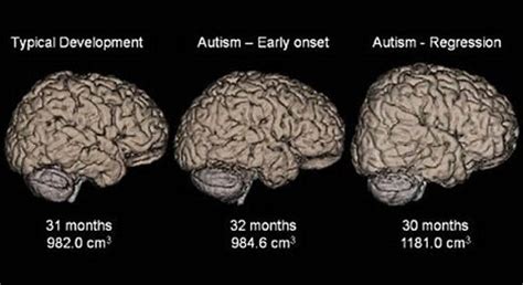 MRI Technique Shows Brain Differences in People on Autism Spectrum ...