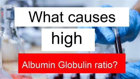 What causes high Albumin Globulin ratio and low TSH 3?