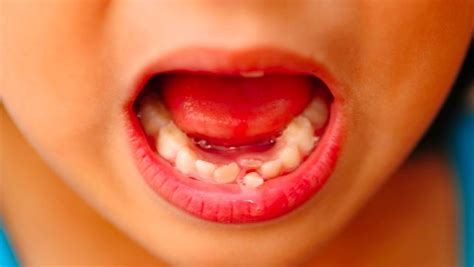 How To Pull A Tooth At Home | Knoxville Family Dentistry