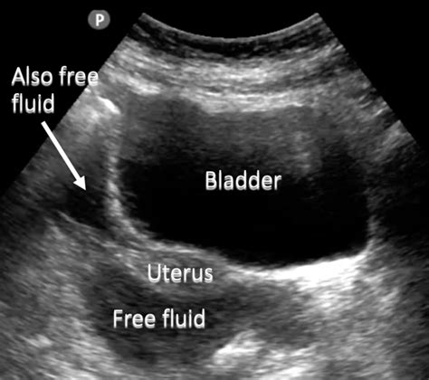 Pelvic Ultrasound: Pelvic Free Fluid