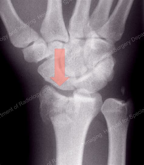 Avoiding Distal Radius Fracture Complications (Broken Wrist) (2023)