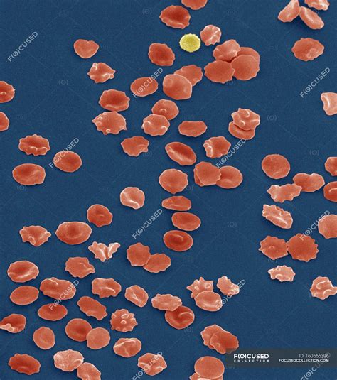 Crenated red blood cells — Micrograph, biological - Stock Photo ...