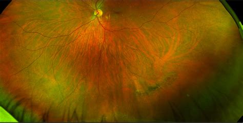 Sonoran Desert Eye Center: ATROPHIC RETINAL HOLE WITHIN LATTICE