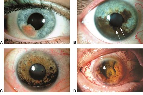 Iris melanoma - American Academy of Ophthalmology