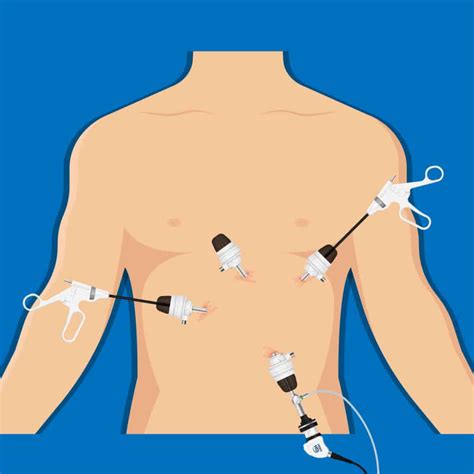 Cirurgia de Hérnia de Hiato/Refluxo – Dr. Christiano Claus