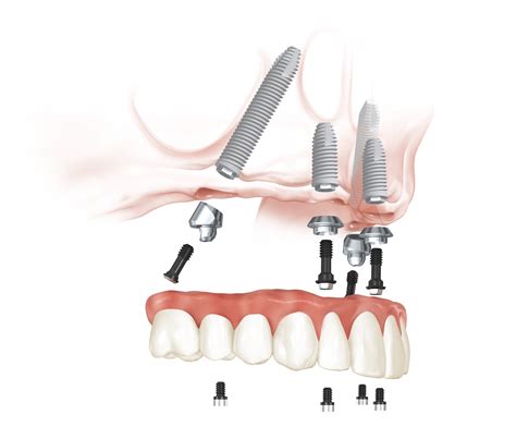 Nobel Biocare introduces the All-on-4® Treatment Concept | Aegis Dental Network