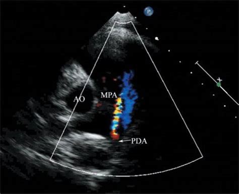 Patent Ductus Arteriosus Echocardiography