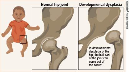 Congenital hip dysplasia Flashcards | Quizlet