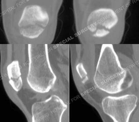 Patella Fractures - Orthopedic Trauma Service