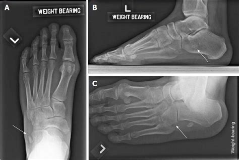 Peroneus Tertius Tendon