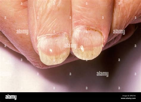 Koilonychia both thumbs Stock Photo - Alamy