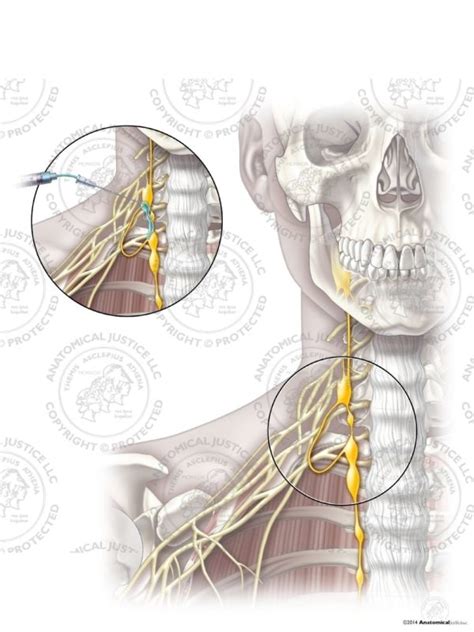 Female Right Stellate Ganglion Block - No Text