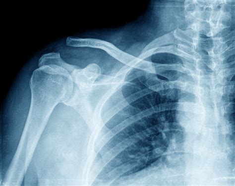 What are the symptoms of an acromioclavicular joint disorder? | Exception MD