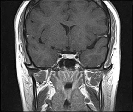 Pituitary Tumor Mri