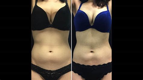 Lipo Light Body Contouring Before And After | Shelly Lighting