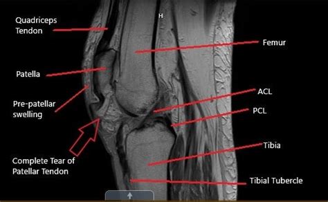 Patellar Tendon Rupture