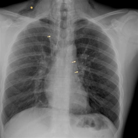 Hamman\'s syndrome - pneumomediastinum, subcutaneous emphysema and pneumorachis | Eurorad