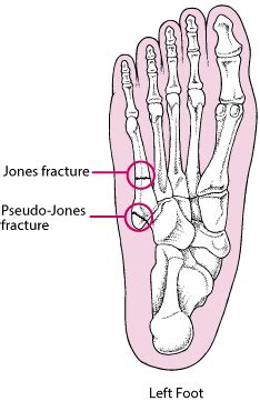 Figure: Jones and Pseudo-Jones Fractures - MSD Manual Consumer Version