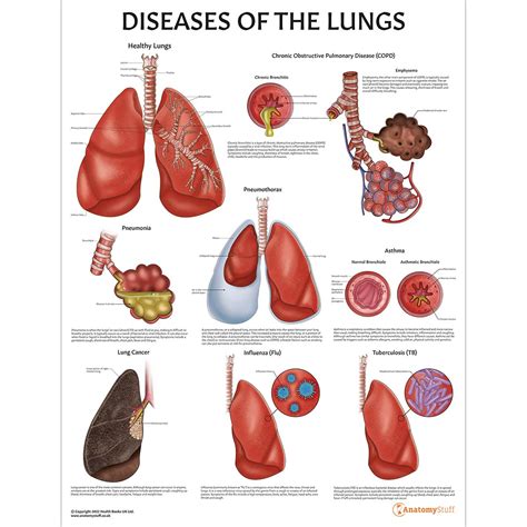 Diseases of the Lungs Chart | AnatomyStuff